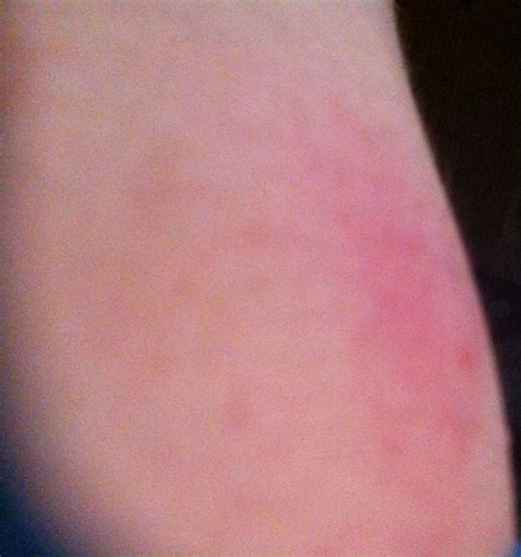 allergic reaction   allergy shot im     arm    painful