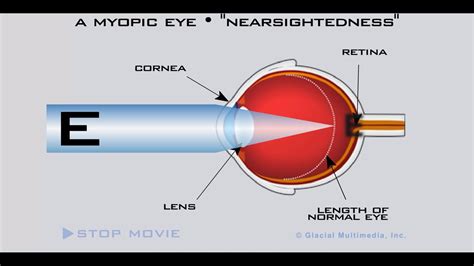 astigmatism hyperopia and myopia are all forms of