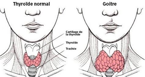 voici comment un mauvais transit intestinal peut provoquer un dérèglement de la thyroïde et 6