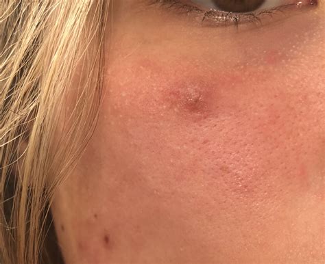 mysterious bump  eye     month general acne