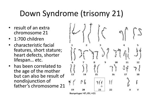 Ppt Down Syndrome Trisomy 21 Powerpoint Presentation