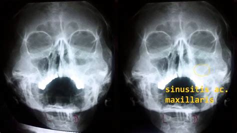 X Ray Sinuses And Nasal Bones Youtube