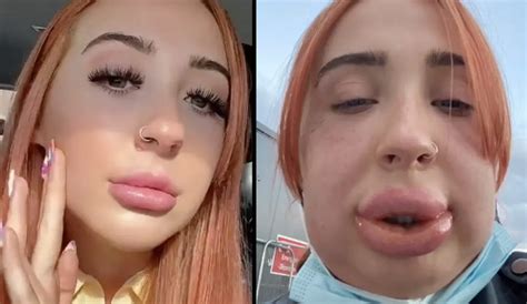 Woman Has Severe Allergic Reaction After Getting Lip Fillers Dissolved