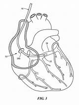 Patents Coronary Sinus sketch template