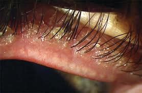 eyelash mites eyelash demodex mites
