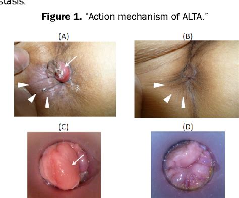 figure 2 from minimally invasive treatment of advanced hemorrhoids and ultrasound imaging of