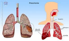 basilar pneumonia differential diagnosis   thoracic spine