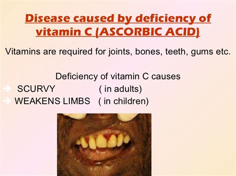 What Does Deficiency Of Vitamin C Cause