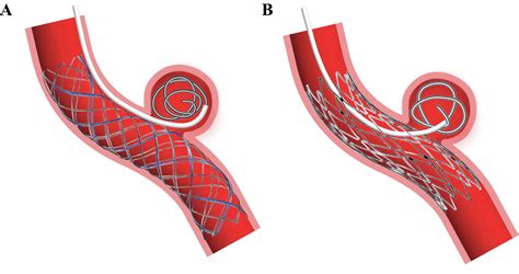 clinical  angiographic outcomes  stent assisted coiling