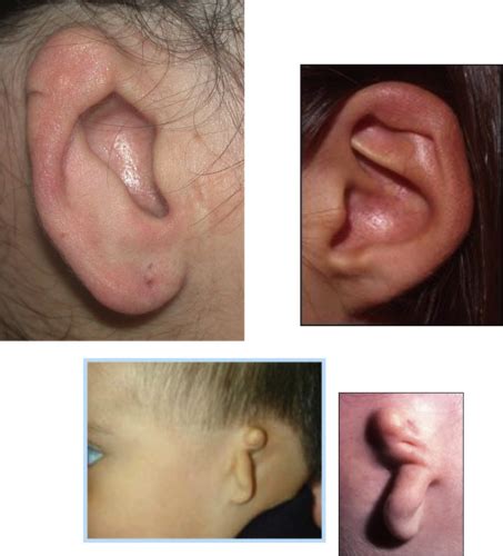 pathologies   outer ear flashcards quizlet