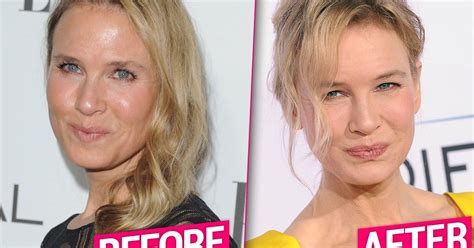 Renee Zellweger’s Possible Plastic Surgery Makeover Revealed Claim Top Docs