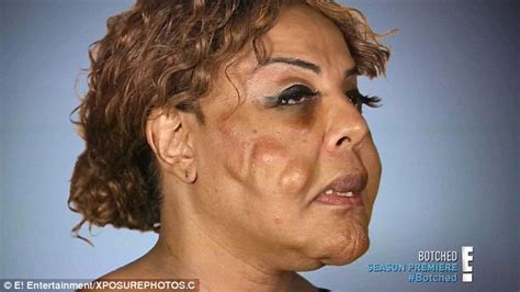 Transgender Woman Who Had Cement And Tire Sealant Injected