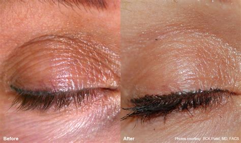 laser skin resurfacing  ipl smooth texture improve complexion