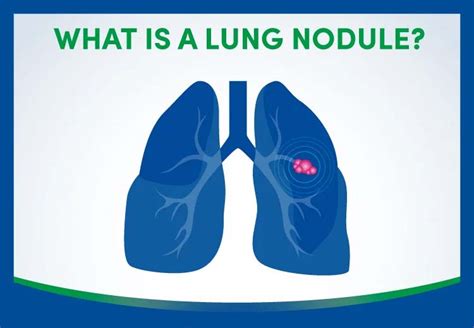 lung nodule infographic