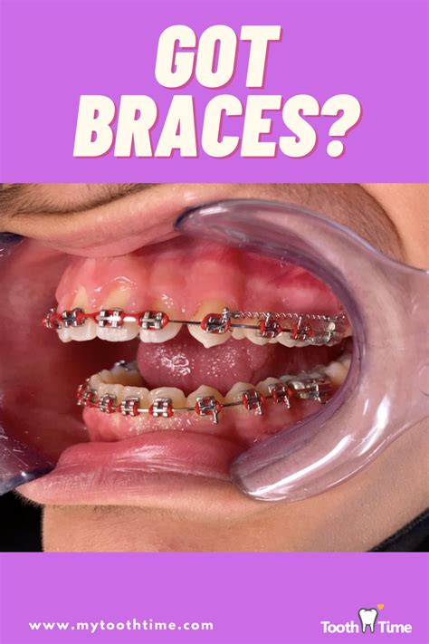 got a spring in your braces in 2021 braces spring teeth