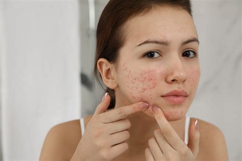 teen girl with acne problem squeezing pimple indoors wockhardthospitals