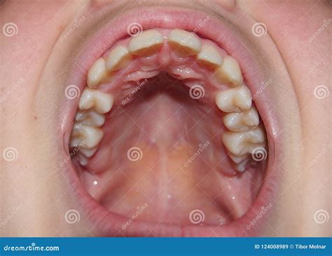upper jaw  healthy teeth close  stock image image  dentistry