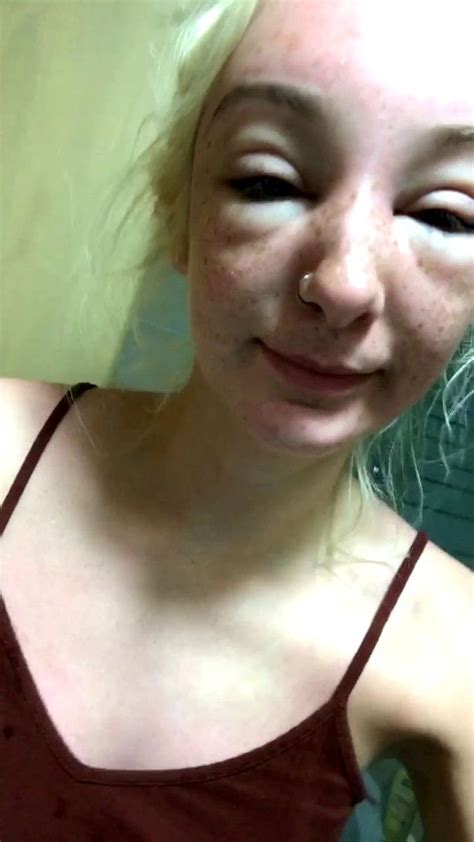 woman s face badly swollen after she gets sun poisoning on holiday