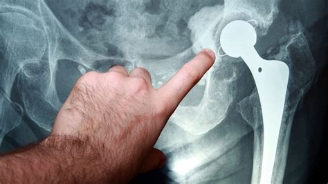 Hip Joint Replacement Characteristics Causes Treatment