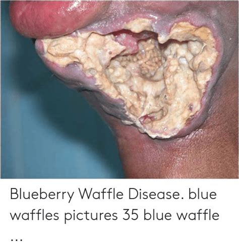 Blueberry Waffle Disease Blue Waffles Pictures 35 Blue