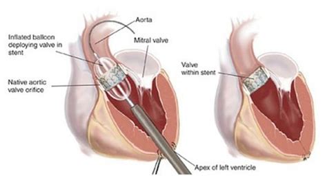 Pin On Heart Valve Replacement