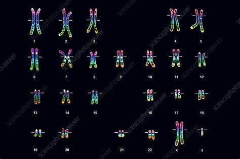 Klinefelters Syndrome Karyotype Male Stock Image C003 7183