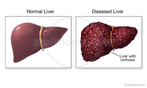 normal liver and liver with cirrhosis