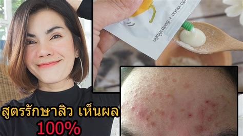 สูตรพอกหน้าจัดการสิว งบ50 บาท Lรักษาสิวด้วยตัวเอง L ถูกและดีในเซเว่น