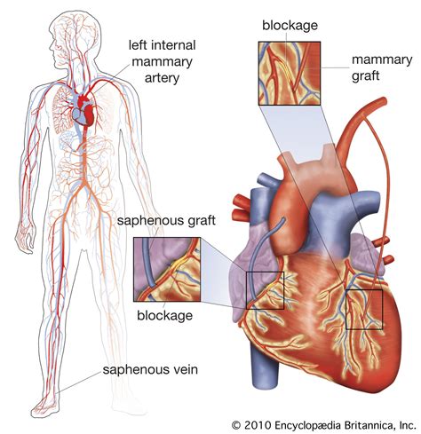 coronary artery bypass heart disease cardiac care grafting