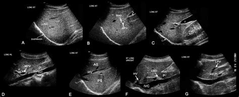 Ultrasound [nick S Radiology Wiki]