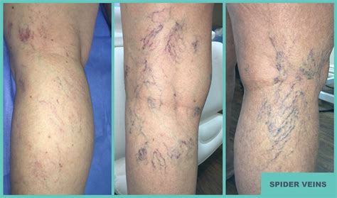 vein disease symptoms arlington tx leg pain treatment arlington tx