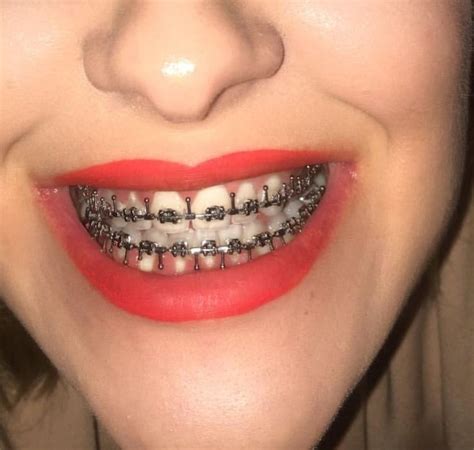 Pin On Mouth Braces