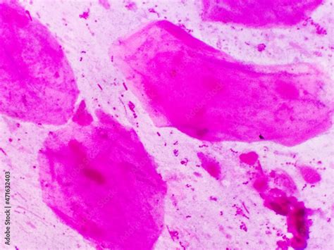Prostatic Smear For Gram Staining Microscopic 100x Show Neisseria