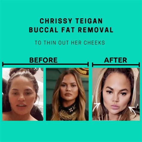 buccal fat removal atlanta ga