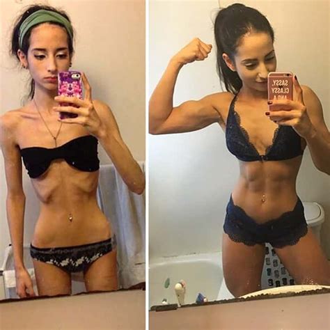 45 ‘before And After’ Photos Of People Who Beat Anorexia True Activist