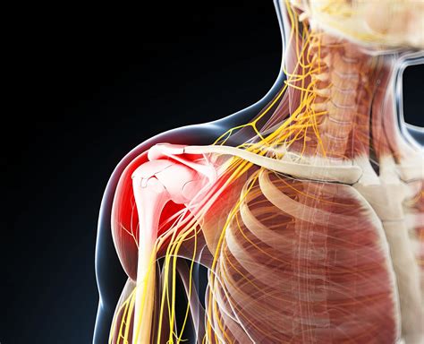 shoulder pain  td patients   due  subacromial disorders