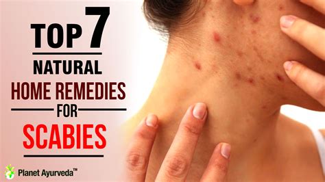 top 7 natural home remedies for scabies