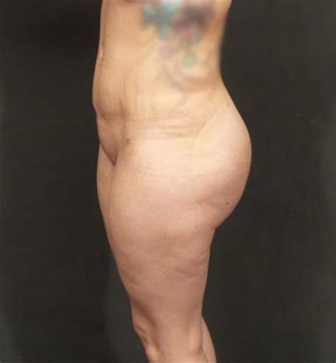 brazilian butt lift seattle plastic surgery best