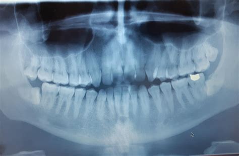 impacted  wisdom teeth pretty painful  infected      molar