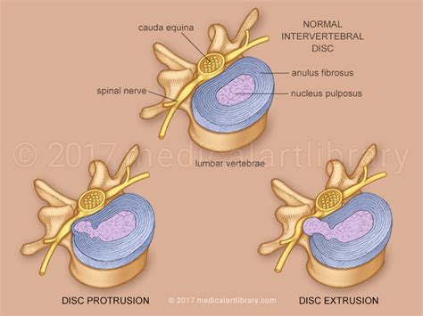 herniated disc medical art library