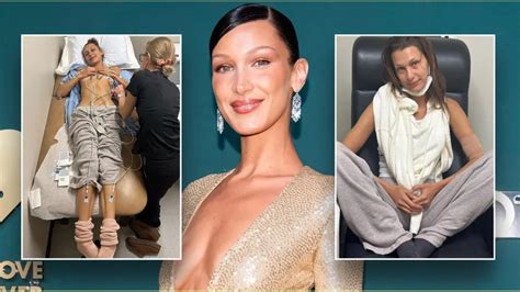 bella hadid illness her struggle with lyme disease and what it is