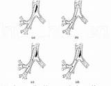 Balloon Dilation Figure Tracheobronchial Bronchoscopic Stenosis Benign Bbd sketch template