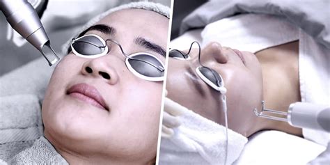 Up To 42 Off Pico Laser Flawless And Glowing Skin Premier Clinic