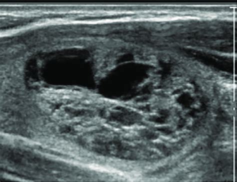 thyroid  showing  cystic spongiform nodule compatible   benign