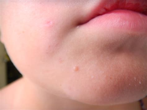 facial warts symptom   treatment  health advisor