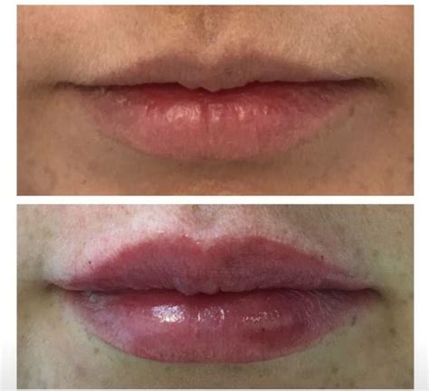 lip fillers in essex at our chelmsford clinic basildon prices and