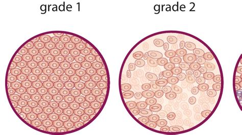 what are the grades and stages of vaginal cancer irish cancer society