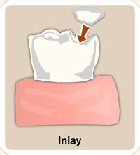 inlays onlays american dental center