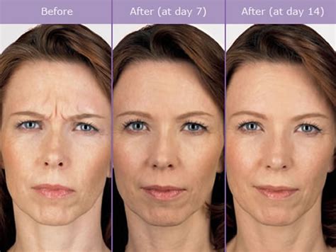 see how botox can help elevate your mood