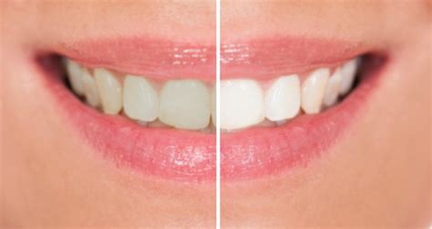5 tips to avoid staining your teeth from coffee and red wine